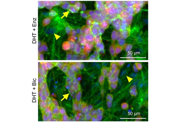 3d modell knochenmetastaten bock et al 2021