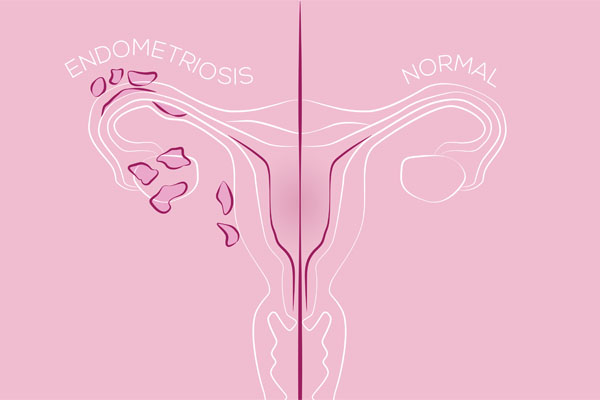 Schema Endometriose