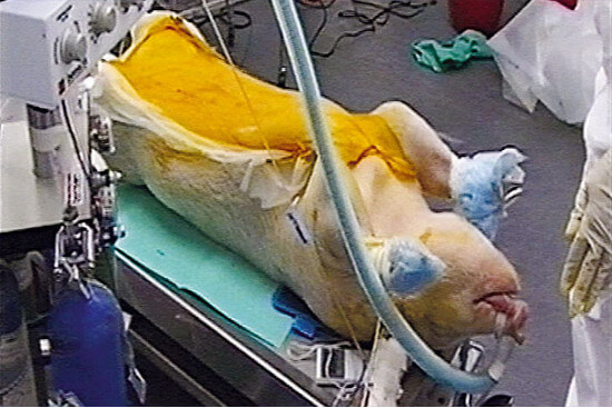 Patient nach Transplantation von Schweineniere gestorben
